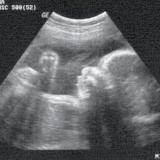 ultrasound-thumb.jpg